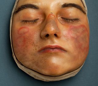 Moulage aus Wachs. Ein Gesicht mit geschlossenen Augen und Hautentzündung.